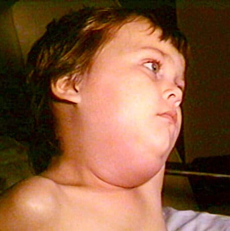 Mumps PHIL 130 lores