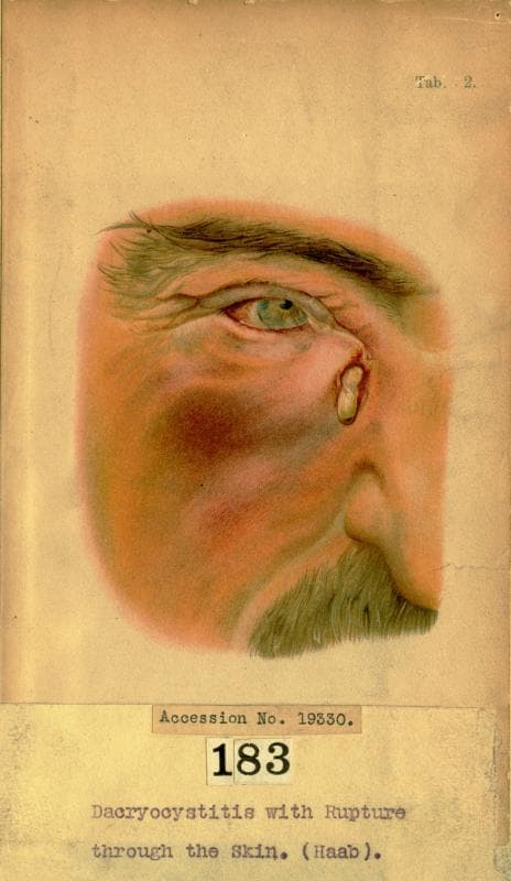 Dacryocystitis with rupture through the skin (Ball 19330), National Museum of Health and Medicine (3380538084)