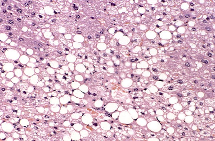 Liver steatosis fatty change